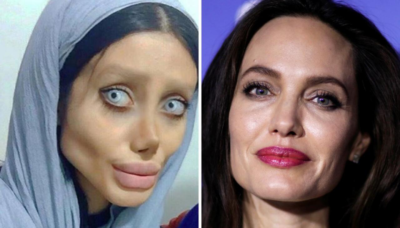 Woman Looks Like Corpse Bride After Surgery To Look Like Angelina