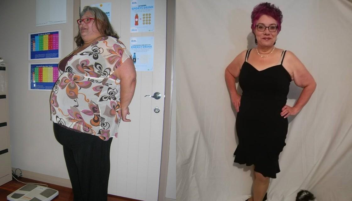 Bariatric surgery not the 'easy way out', woman who lost 92kg says