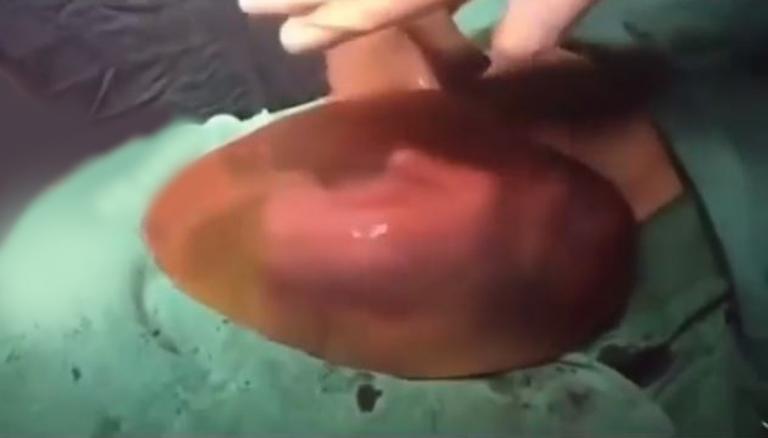 Newborn Kicks Nestles Onto Mother While Still Inside Amniotic Sac In Incredible Birth Video Newshub