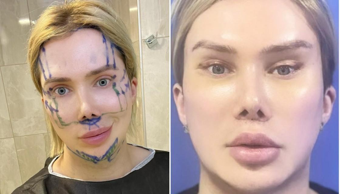 UK-born influencer Oli London spends thousands on plastic surgery to look  Korean