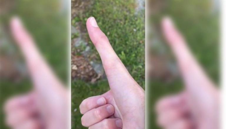 US man goes viral on TikTok for 'biggest thumb in the world