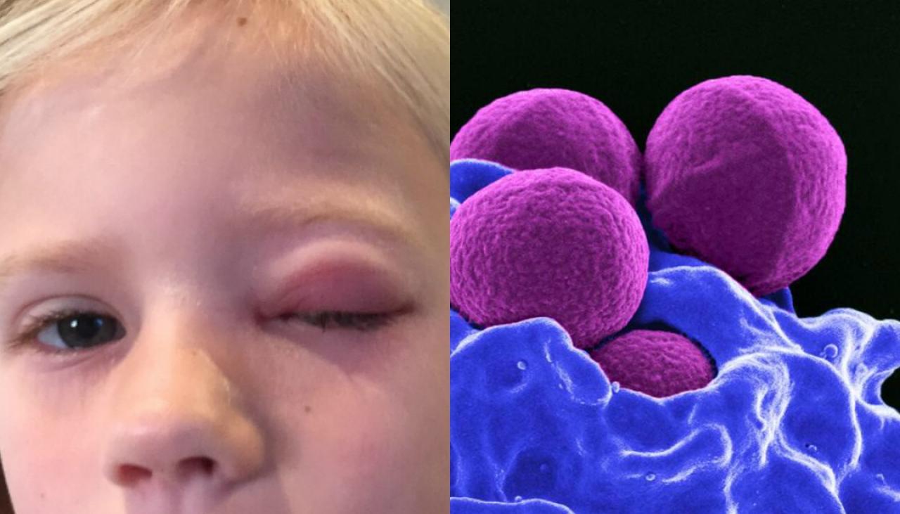 Mrsa Super Bug Symptoms Risk Factors Diagnosis